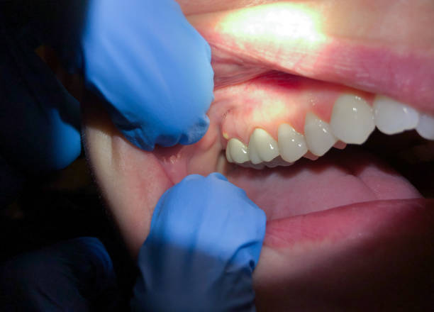 Best Emergency Gum Treatment in Seacliff, CA
